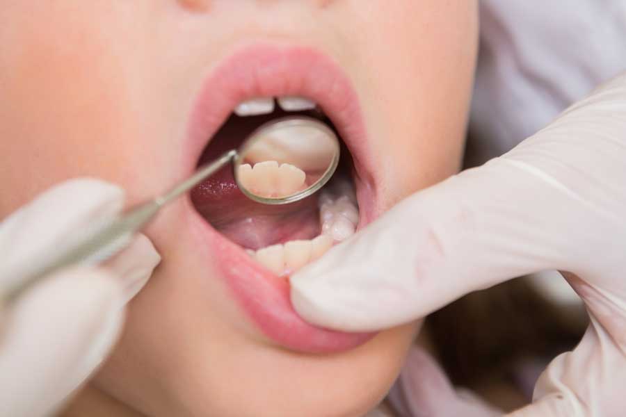 Dental Bonding Houston, Chipped Tooth Houston