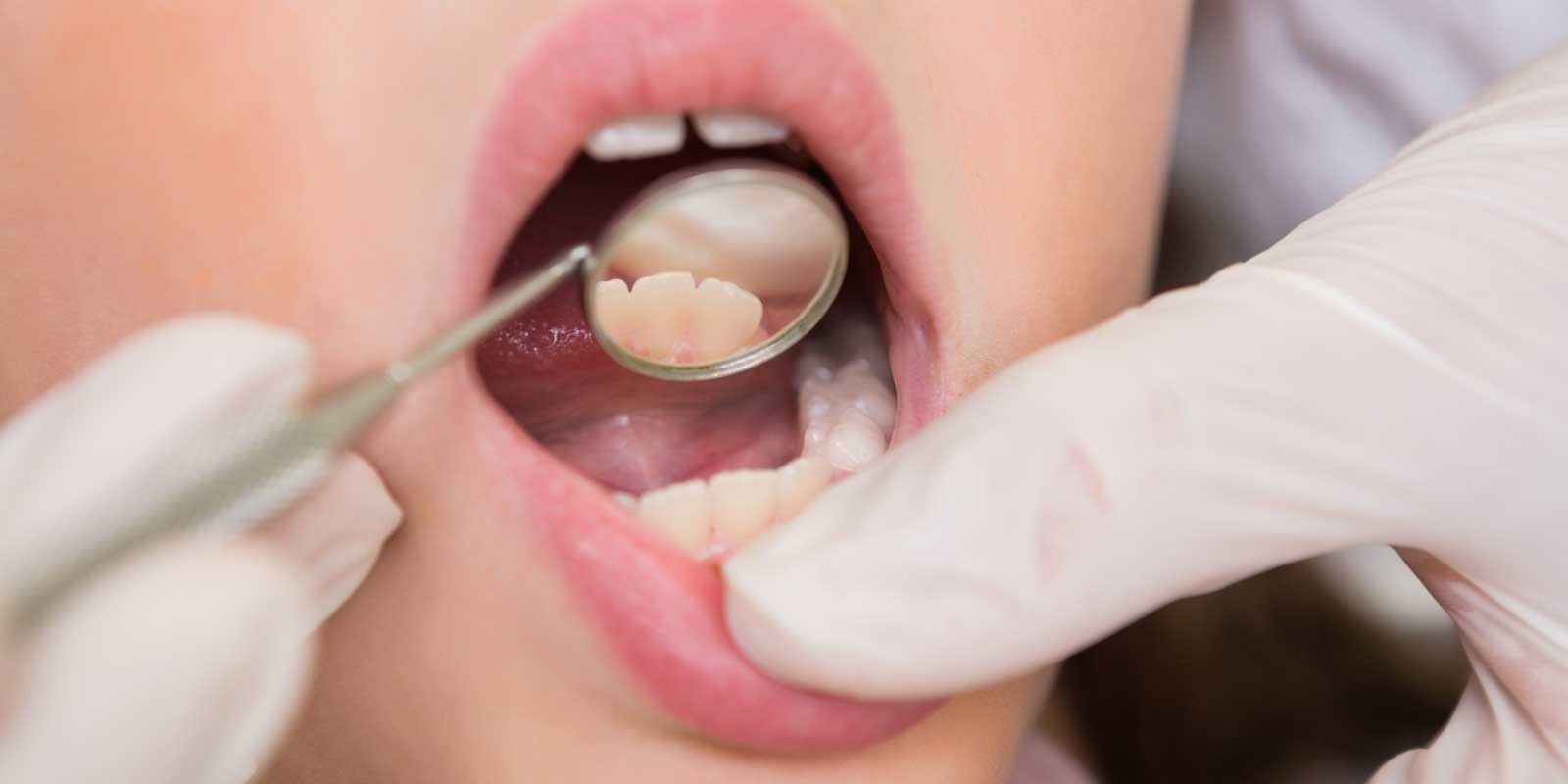 How to Cure Tooth Infection